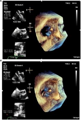 Case Report: Leadless and left bundle branch area pacemakers, complementary advantages require a personalized approach